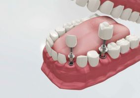 dental implantology courses phuket AB Dental Clinic Phuket :Dentist