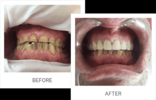 teeth whitening in phuket AB Dental Clinic Phuket :Dentist