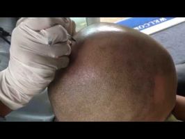 hair graft clinics in phuket Phuket Hair Loss Clinic